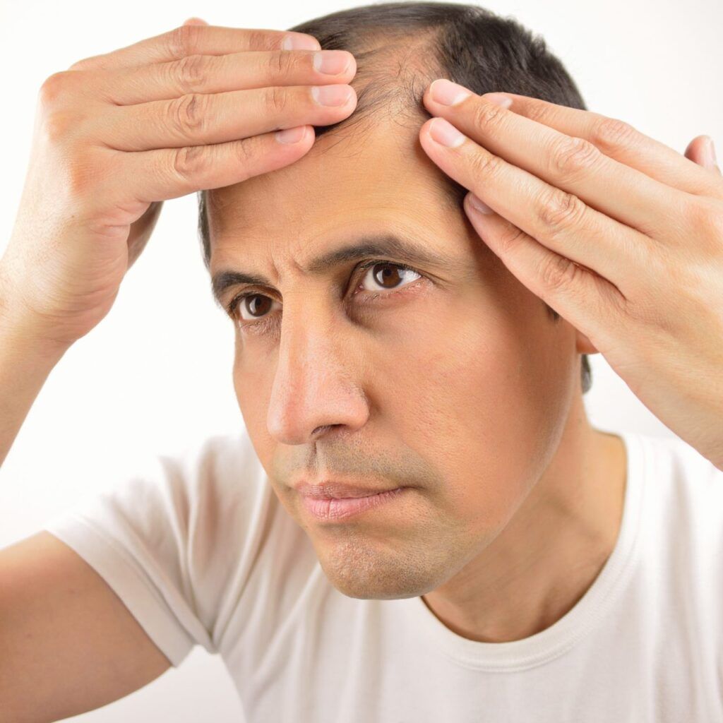 caída del cabello en hombres