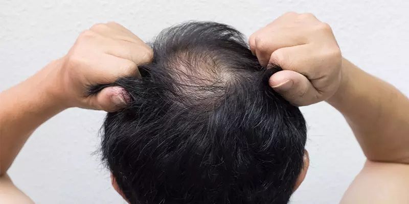 LLLT en alopecia avanzada